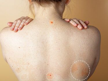 Dermatitis atópica: causas, síntomas y tratamiento