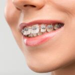 Todo sobre la ortodoncia